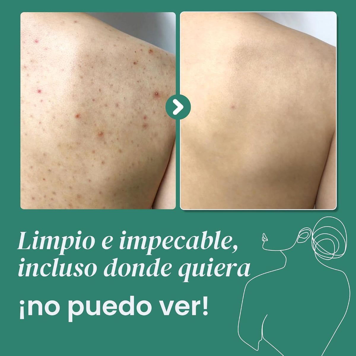 GEL DE BAÑO ANTI ACNE [PV1-WHATSAPP-TRENDSHOP]