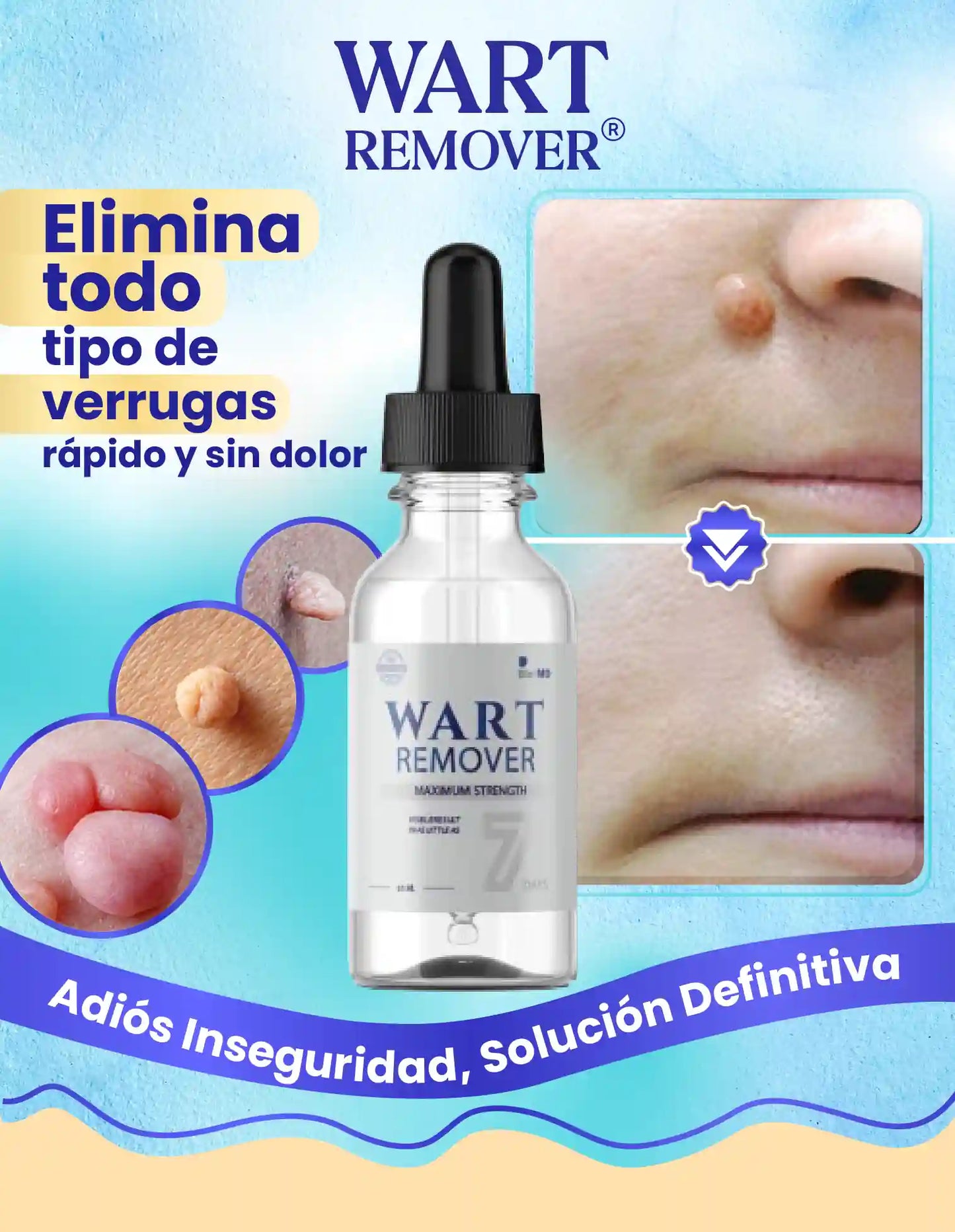REMOVEDOR DE VERRUGAS WART REMOVER [PV1-WHATSAPP-TRENDSHOP]