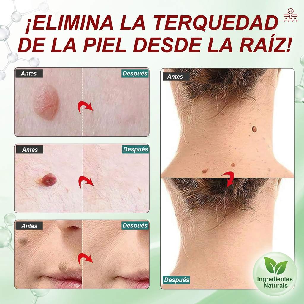 CREMA PARA ELIMINAR VERRUGAS [PV1-WHATSAPP-TRENDSHOP]
